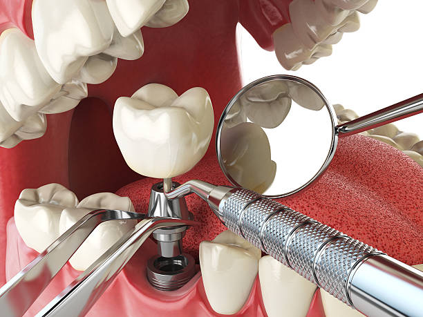 Best Knocked-Out Tooth (Avulsed Tooth) Treatment in Champlin, MN